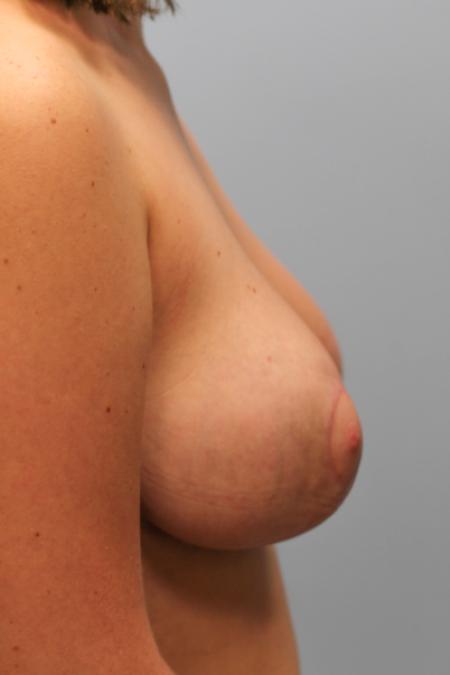 After image 3 Case #108101 - Breast Reduction
