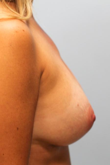 After image 3 Case #107786 - Breast Augmentation