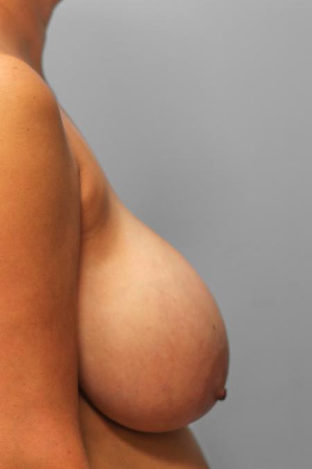 Before image 3 Case #107646 - Breast Reduction