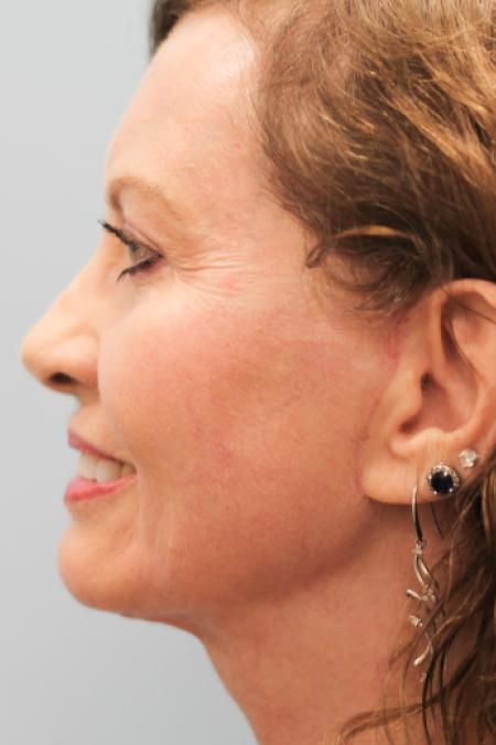 After image 3 Case #107796 - Facelift