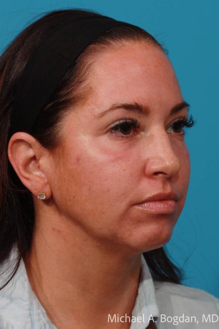 After image 4 Case #108296 - Blepharoplasty