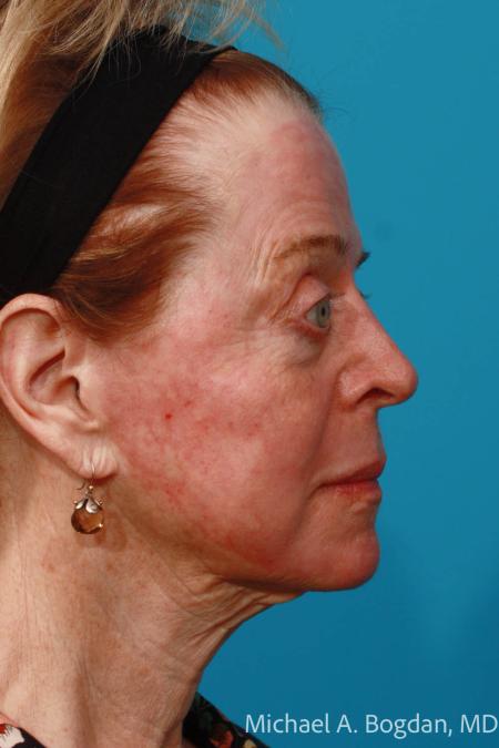 After image 3 Case #108366 - Full Face Erbium Resurfacing