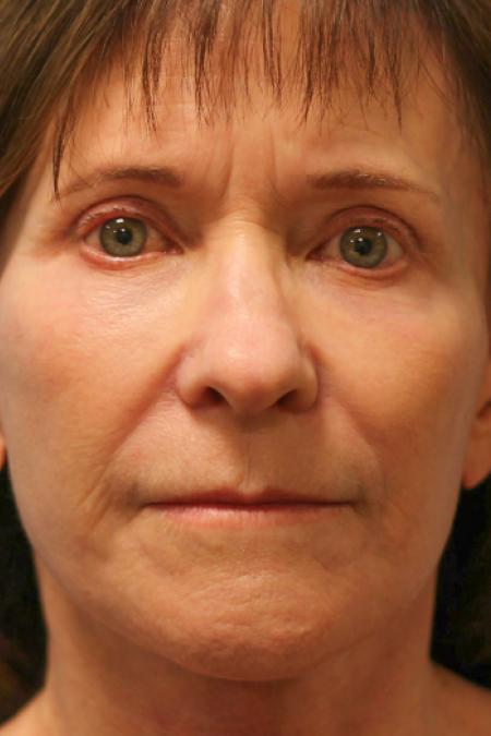 After image 1 Case #108286 - Facelift & Blepharoplasty