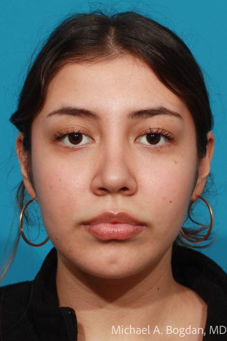 After image 1 Case #108436 - Rhinoplasty