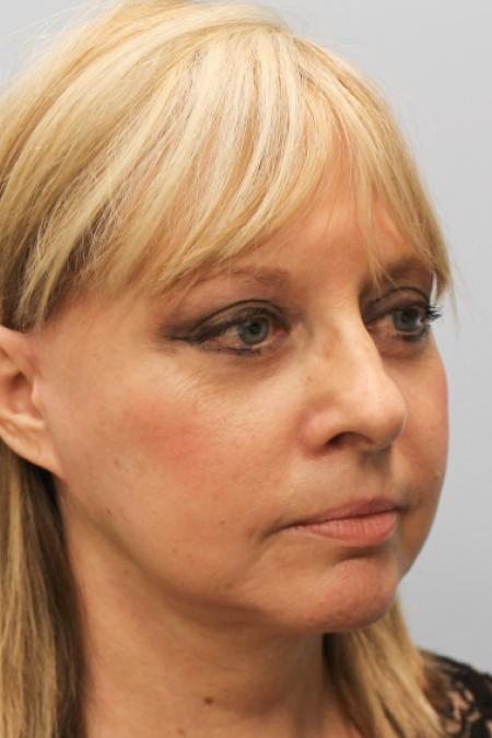 After image 2 Case #108151 - Facelift & Blepharoplasty