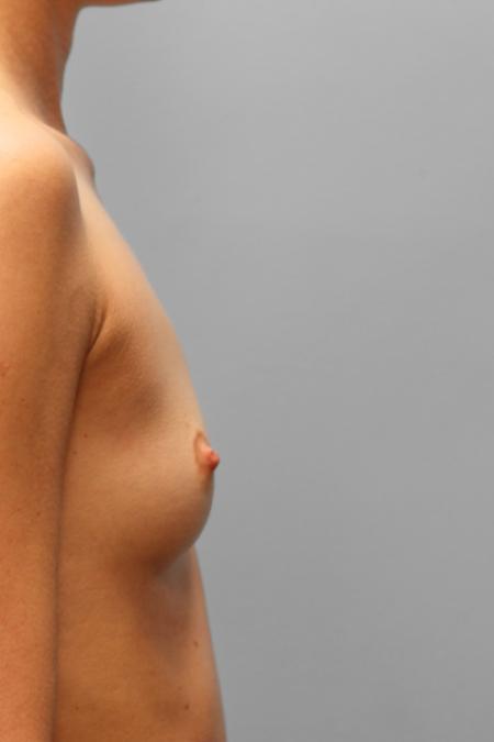 Before image 3 Case #108261 - Breast Augmentation