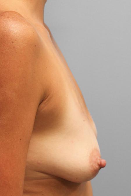 Before image 3 Case #107736 - Breast Augmentation