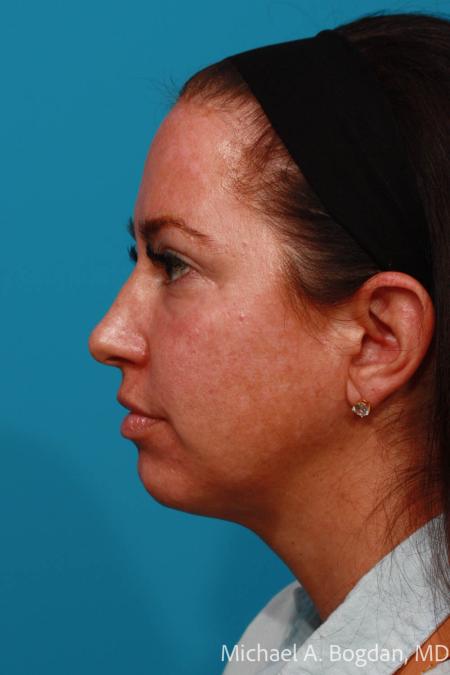 After image 3 Case #108296 - Blepharoplasty