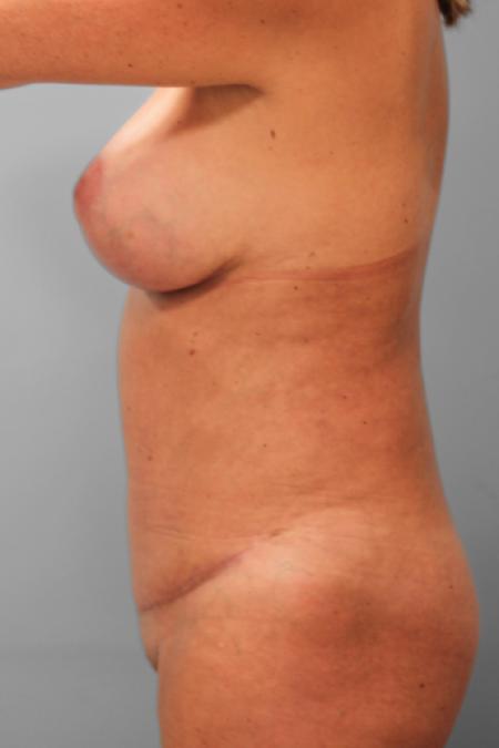 After image 3 Case #107761 - Mommy Makeover