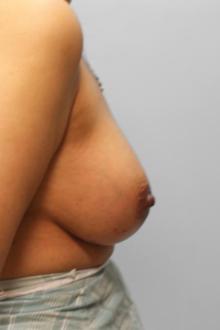 After image 3 Case #107996 - Breast Augmentation