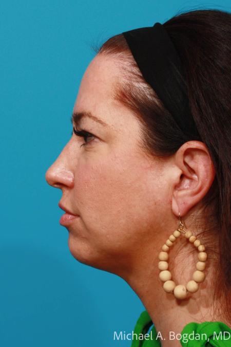 Before image 3 Case #108296 - Blepharoplasty