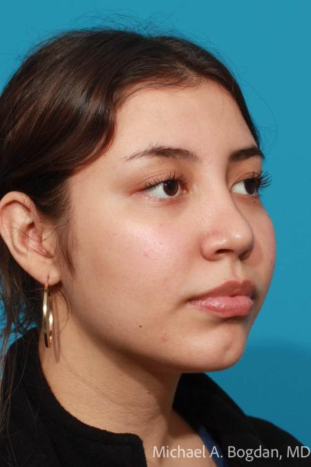 After image 2 Case #108436 - Rhinoplasty