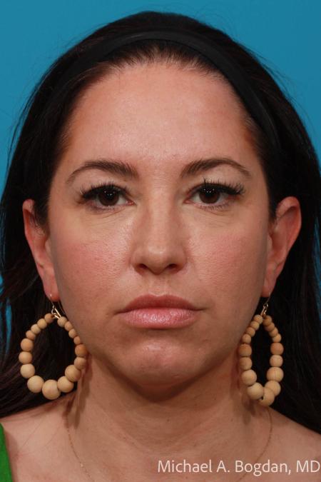 Before image 1 Case #108296 - Blepharoplasty
