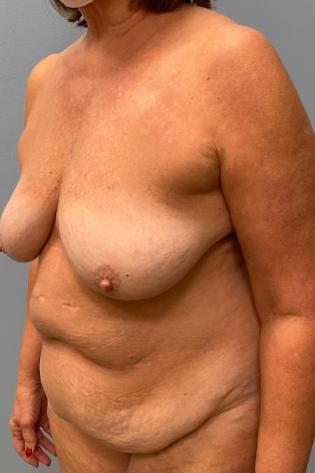 Before image 2 Case #107666 - Mommy Makeover