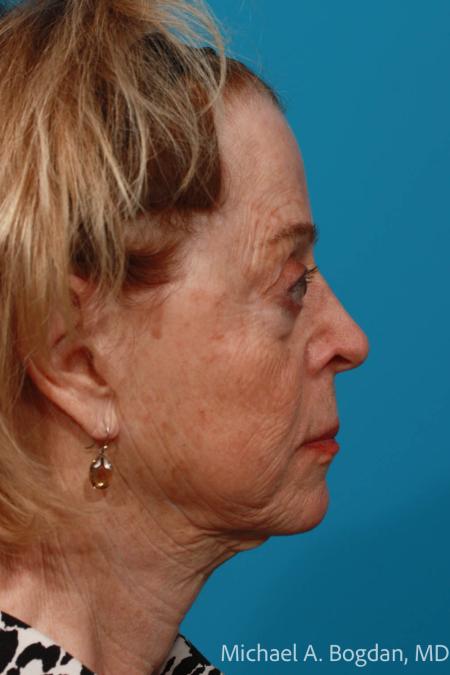 Before image 3 Case #108366 - Full Face Erbium Resurfacing