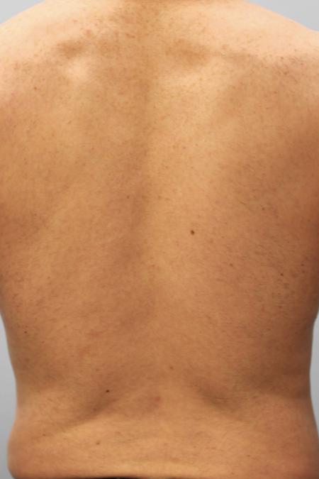 After image 3 Case #107556 - SmartLipo