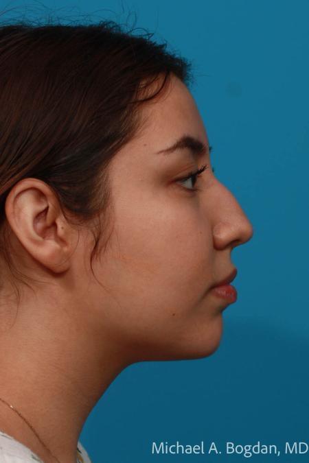 Before image 3 Case #108436 - Rhinoplasty