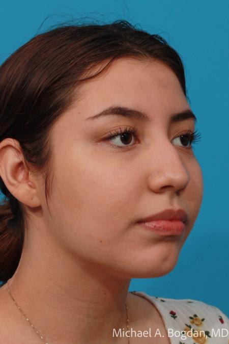 Before image 2 Case #108436 - Rhinoplasty