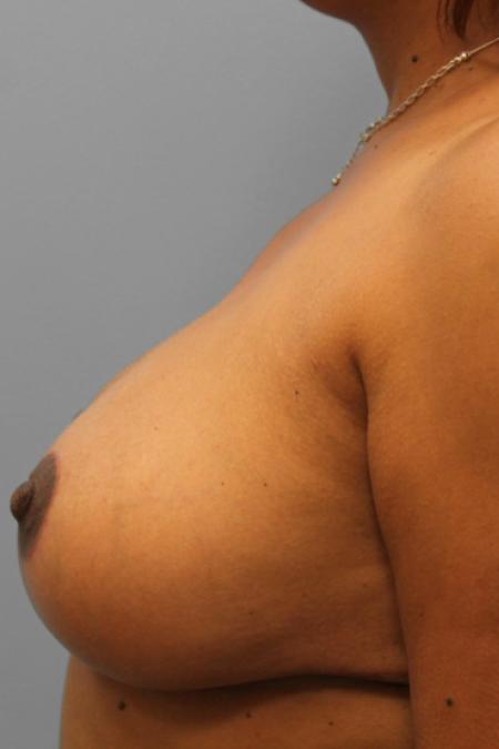 After image 3 Case #108266 - Breast Reduction