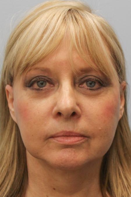 After image 1 Case #108151 - Facelift & Blepharoplasty