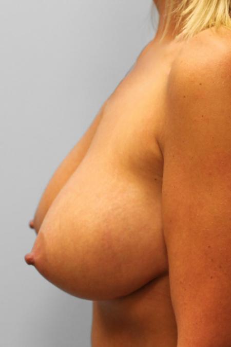After image 3 Case #107956 - Breast Augmentation