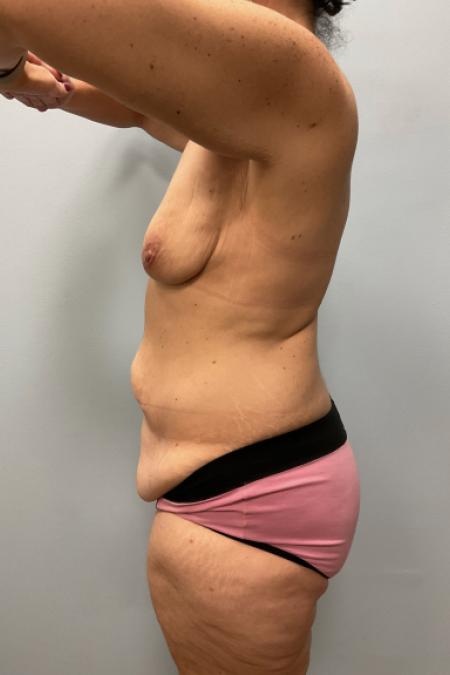 Before image 3 Case #108161 - Tummy Tuck & Arm Lift