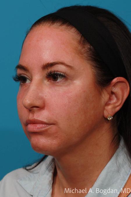 After image 2 Case #108296 - Blepharoplasty