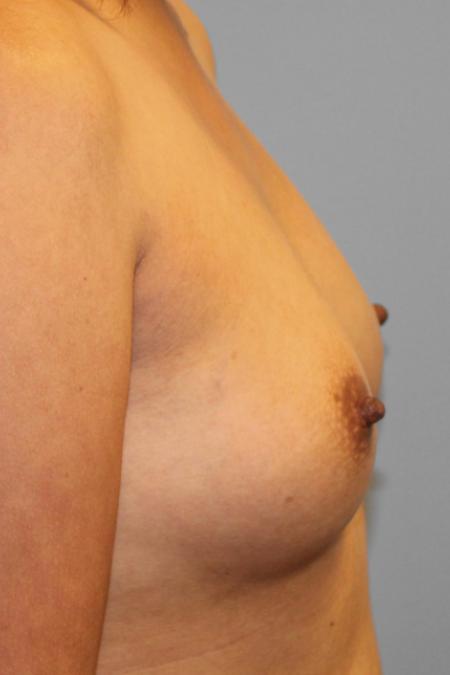 Before image 3 Case #107751 - Breast Augmentation