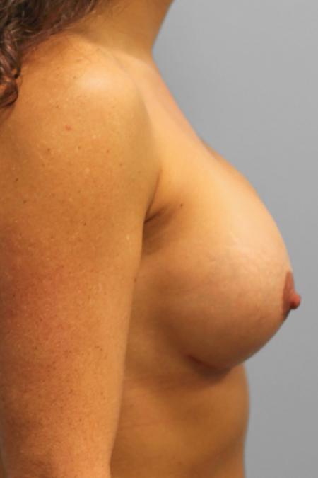 After image 3 Case #108041 - Breast Revision