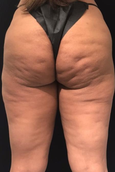 Before Case #107906 - Avéli™ (Minimally Invasive Cellulite Reduction)