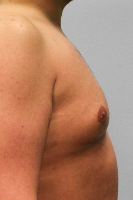 Before image 3 Case #107721 - Gynecomastia Sugery