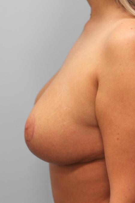After image 3 Case #107756 - Breast Reduction