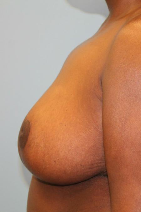 After image 3 Case #108256 - Breast Reduction