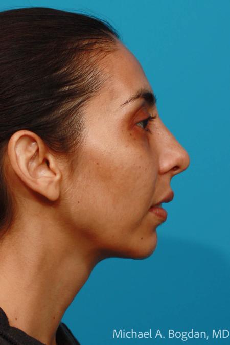 After image 3 Case #108301 - Chin Augmentation