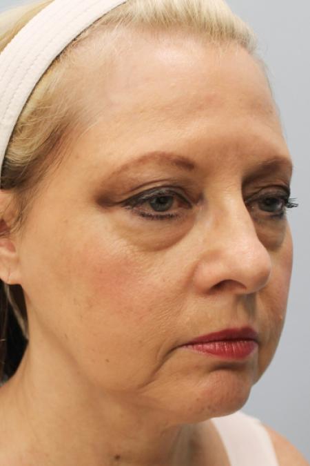 Before image 2 Case #108151 - Facelift & Blepharoplasty