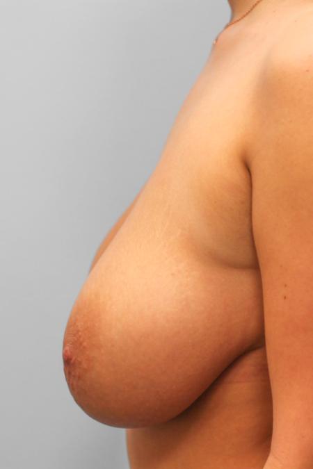 Before image 3 Case #107756 - Breast Reduction