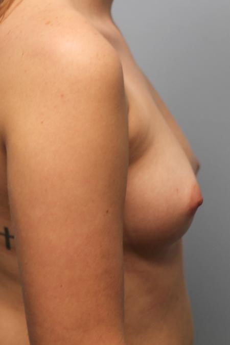 Before image 3 Case #107976 - Breast Augmentation