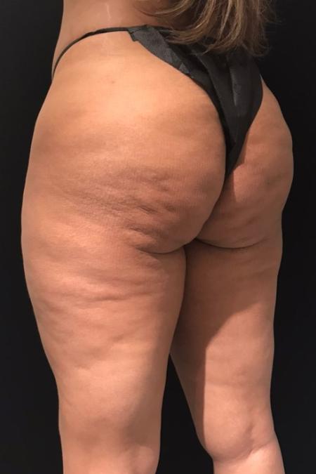 Before Case #107906 - Avéli™ (Minimally Invasive Cellulite Reduction)