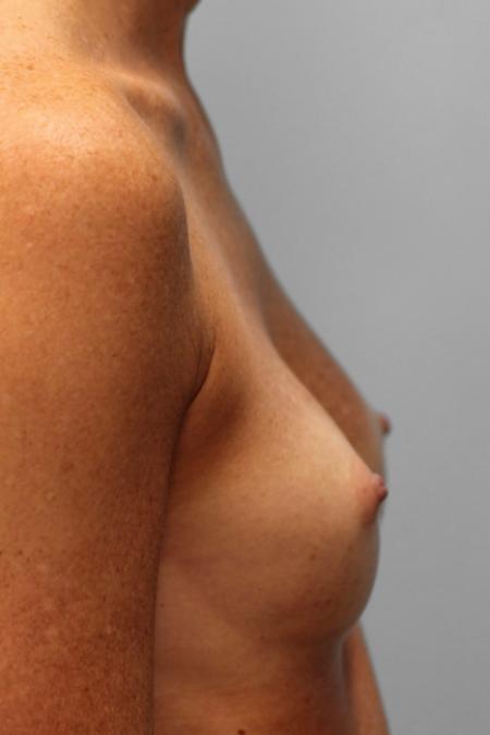 Before image 3 Case #107951 - Breast Augmentation