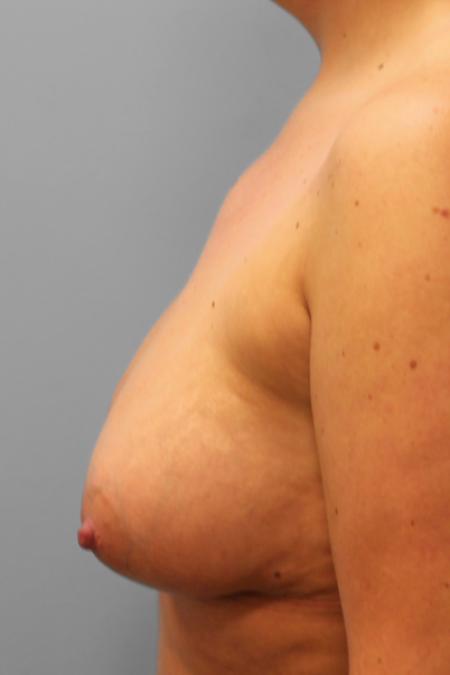 After image 3 Case #107811 - Breast Augmentation