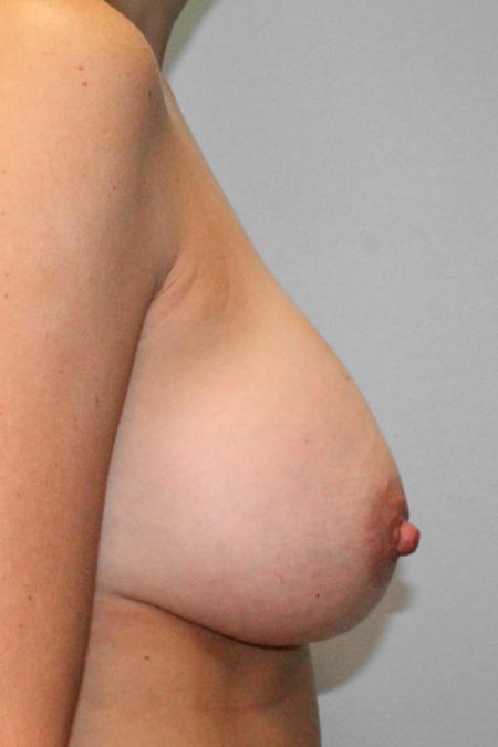 After image 3 Case #107736 - Breast Augmentation