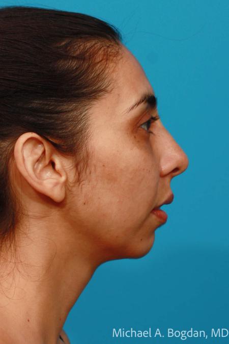 Before image 3 Case #108301 - Chin Augmentation