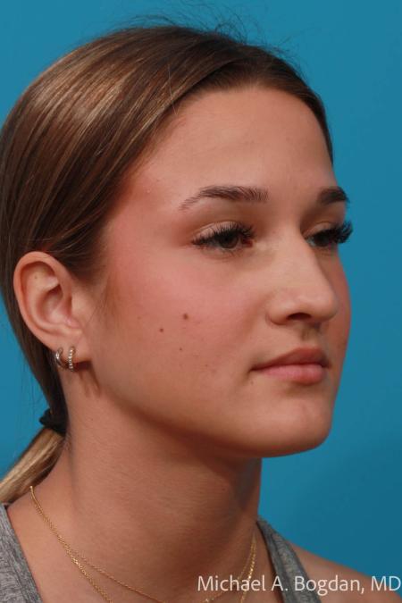 Before image 2 Case #108356 - Rhinoplasty