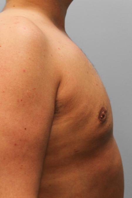 After image 3 Case #107721 - Gynecomastia Sugery