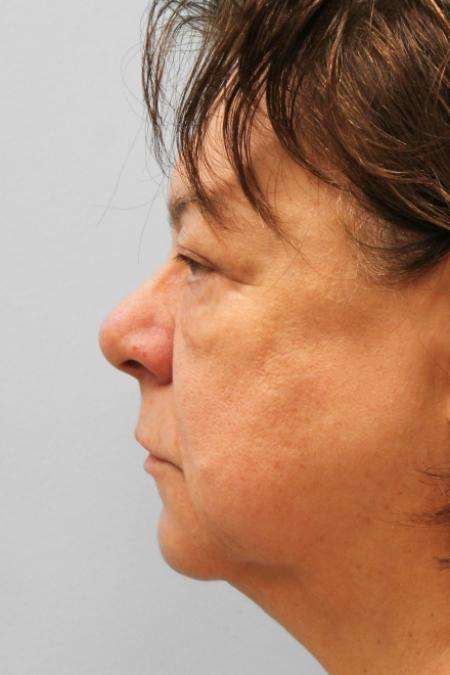 Before image 3 Case #107686 - Facelift