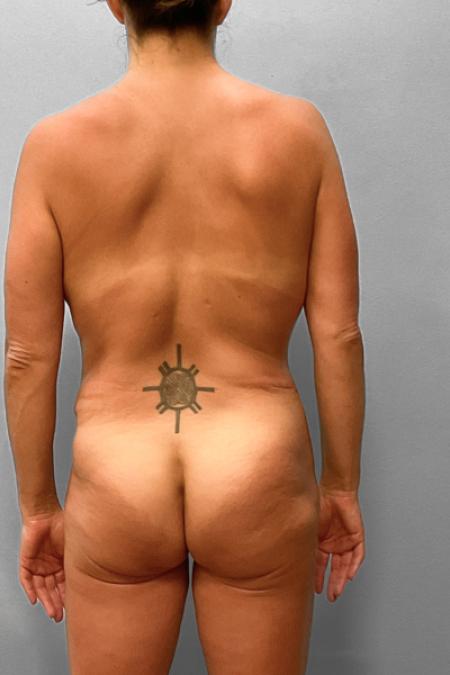 After image 3 Case #107981 - Mommy Makeover