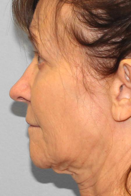 Before image 3 Case #108286 - Facelift & Blepharoplasty