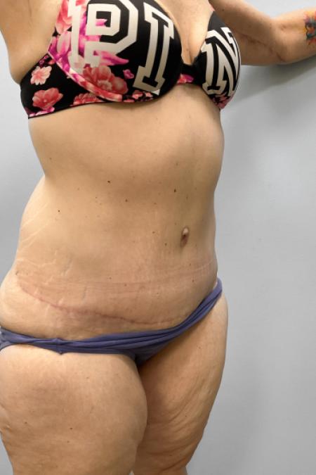 After image 2 Case #108161 - Tummy Tuck & Arm Lift