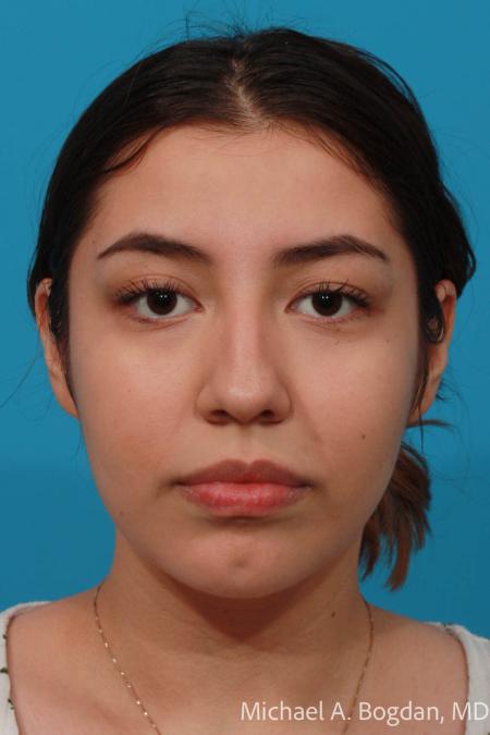 Before image 1 Case #108436 - Rhinoplasty