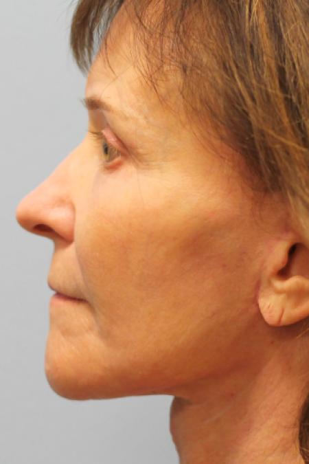 After image 3 Case #108286 - Facelift & Blepharoplasty